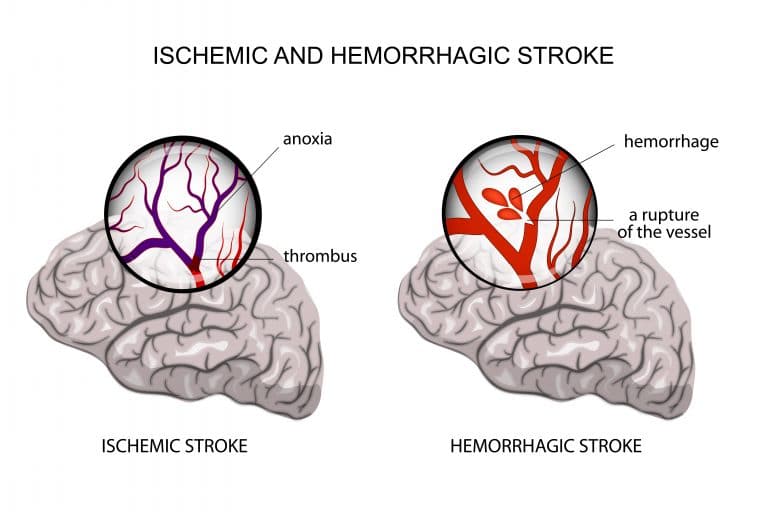 stroke